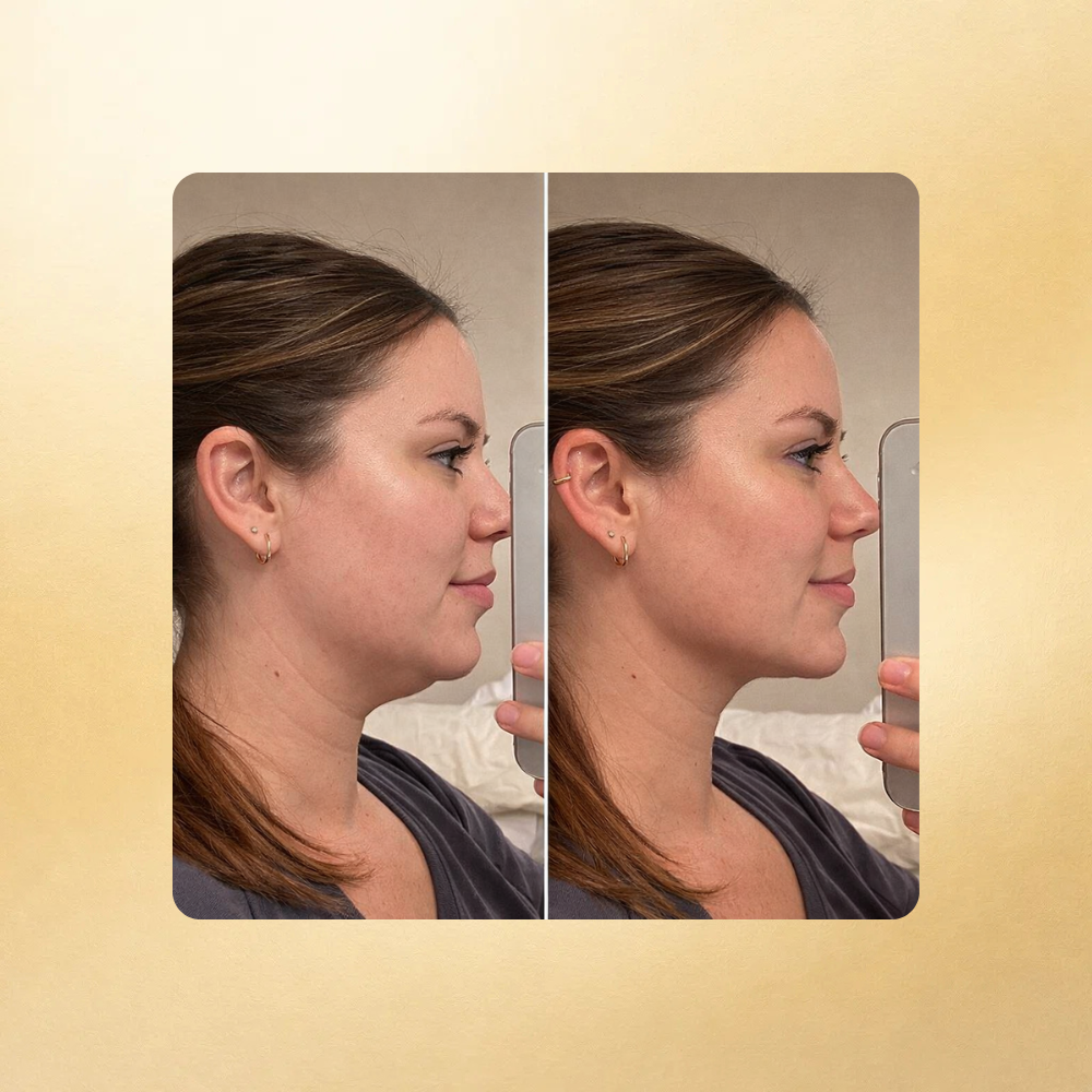 Parches Anti-Papada con colageno Celesté®